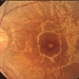 Autosomal Dominant Müller Cell Dystrophy, OS close-up Autosomal Dominant Müller Cell Dystrophy, OS close-up